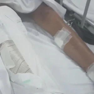 Adolescente de 15 anos atingido por granada de drone do tráfico segue estável em hospital do Rio de Janeiro