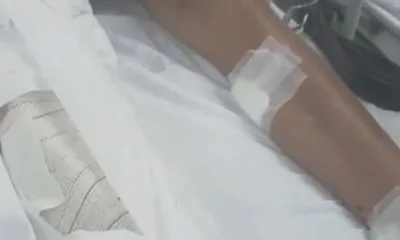 Adolescente de 15 anos atingido por granada de drone do tráfico segue estável em hospital do Rio de Janeiro