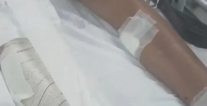 Adolescente de 15 anos atingido por granada de drone do tráfico segue estável em hospital do Rio de Janeiro
